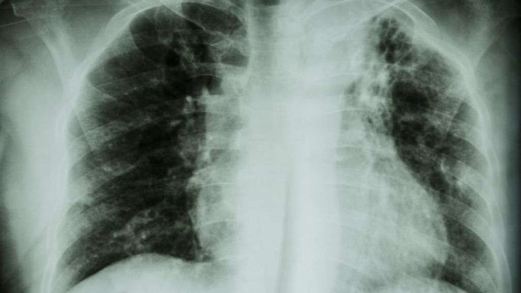 Tuberculosis Tuberculosis