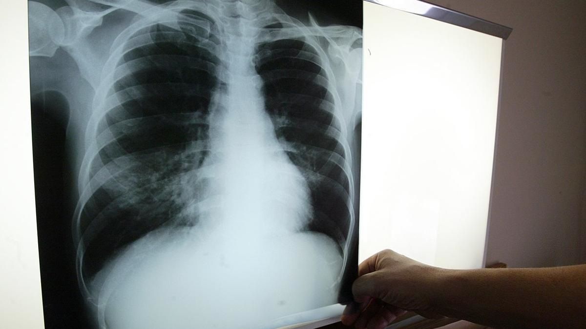 Tuberculosis Tuberculosis