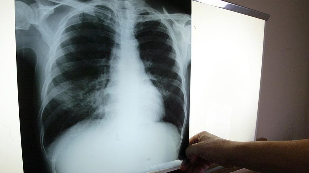 Tuberculosis Tuberculosis