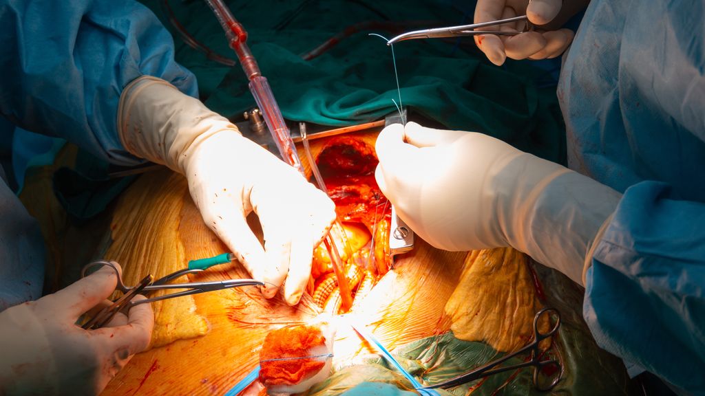 FOTOGRAFIA CIRUGIA AORTA DR FOTOGRAFIA CIRUGIA AORTA DR