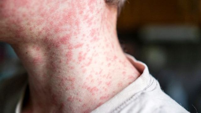 Sarampión Sarampión