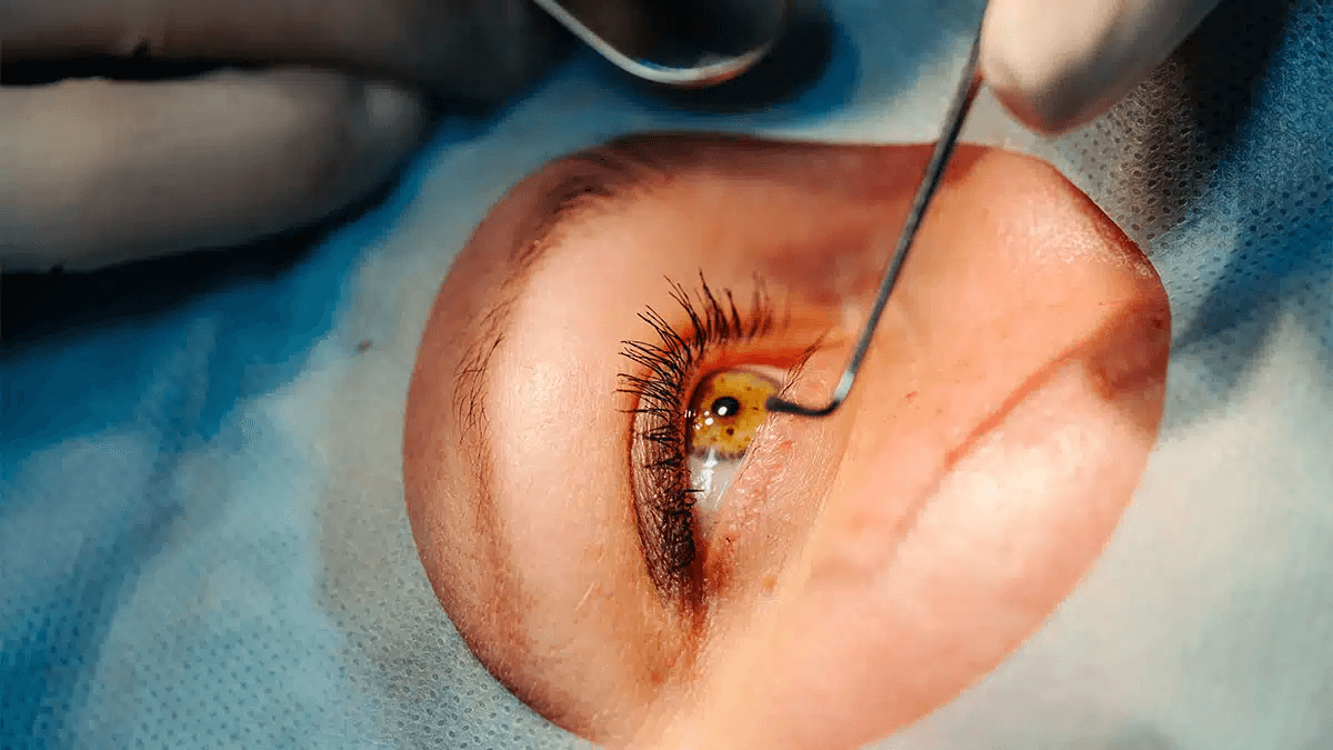 IMAGEN REFERENCIAL CORNEA