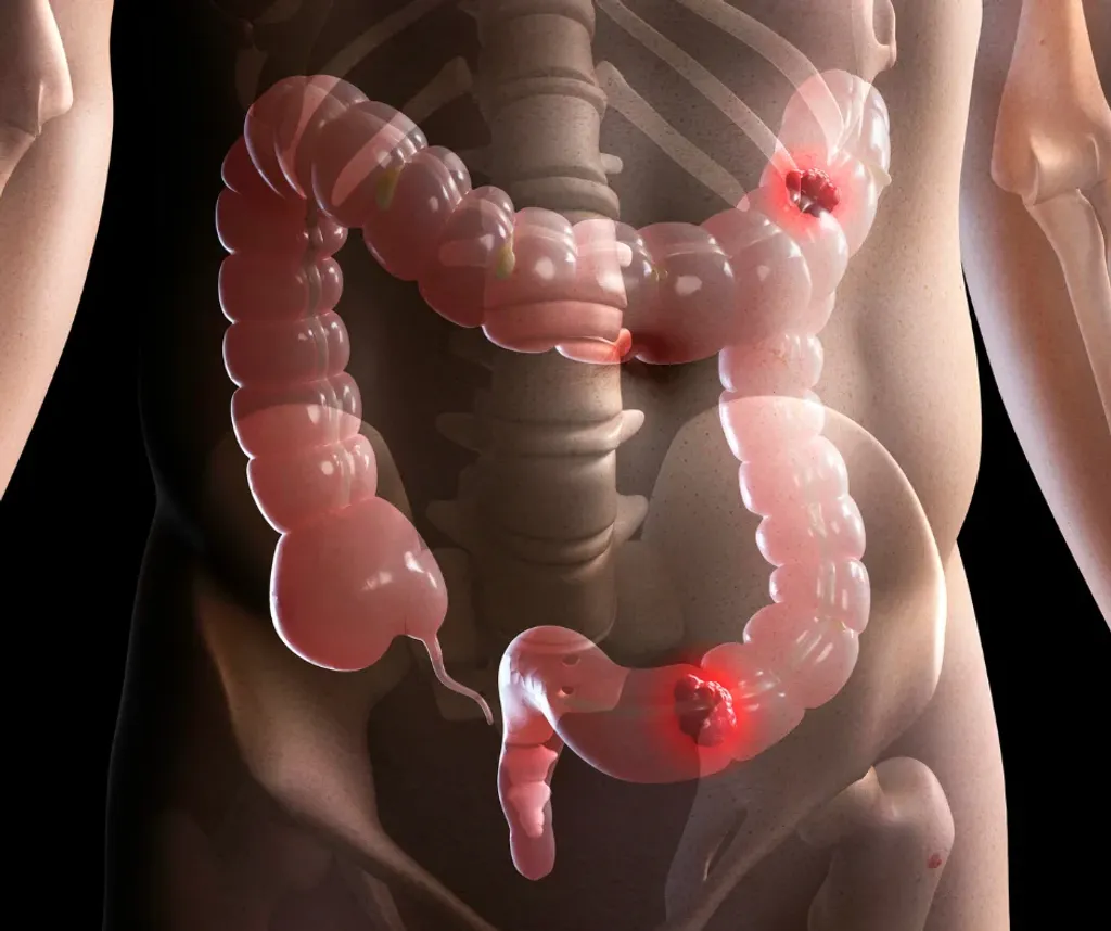 Cancer-colorrectal Cancer-colorrectal