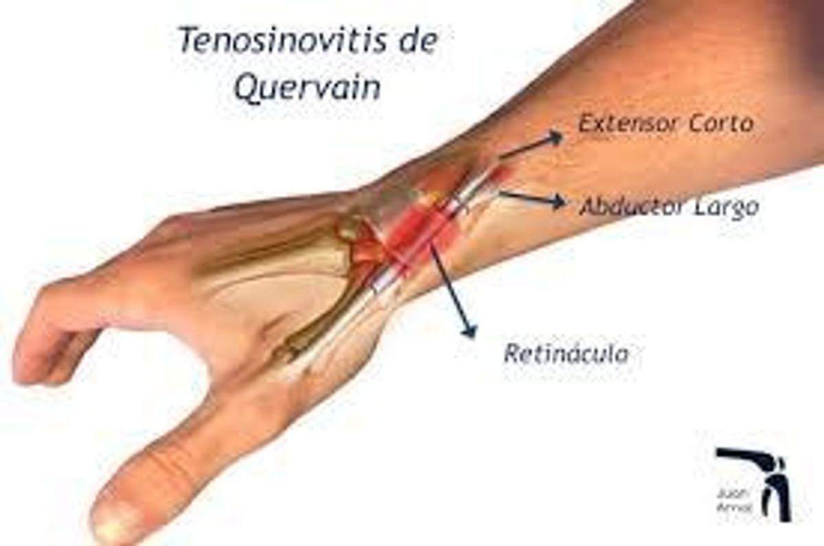 Tendinitis, mucho dolor, pero solucionable Tendinitis, mucho dolor, pero solucionable