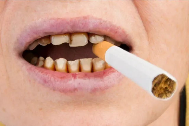 cigarrillo-dientes-manchados-768x512 cigarrillo-dientes-manchados-768x512