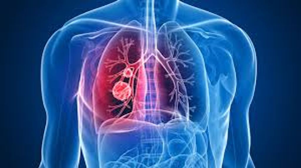 cáncer de pulmón cáncer de pulmón