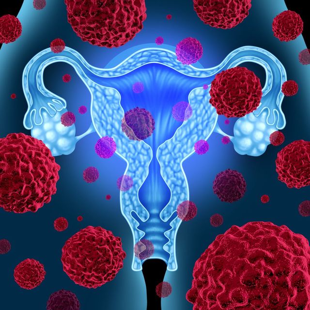 Cancer del cuello cervicouterino VPH