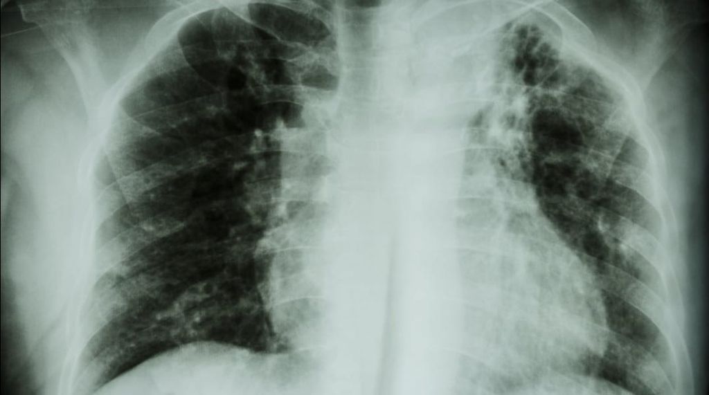 tuberculosis
