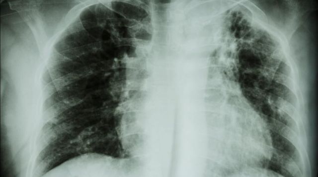 tuberculosis