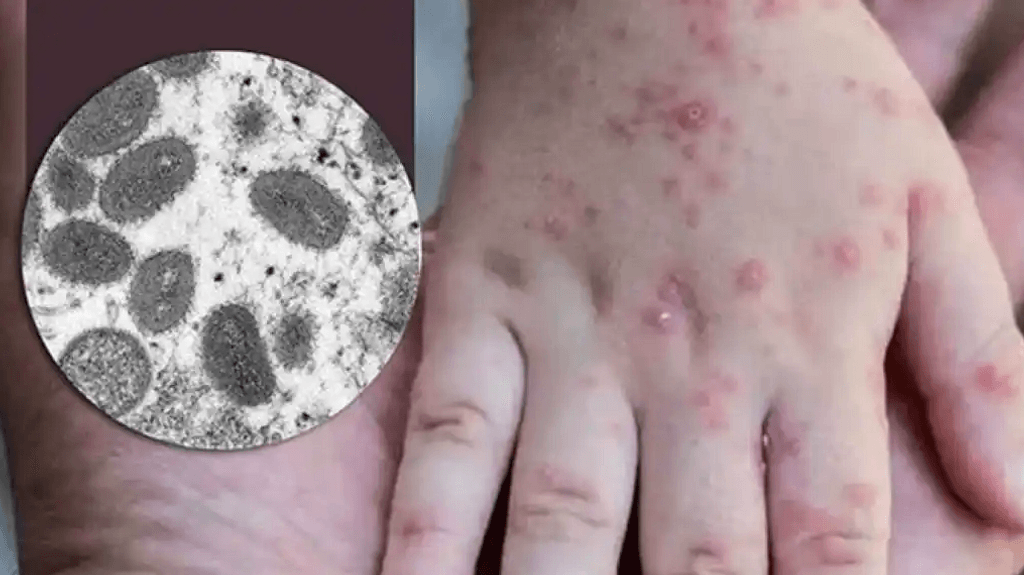 viruela del mono viruela del mono