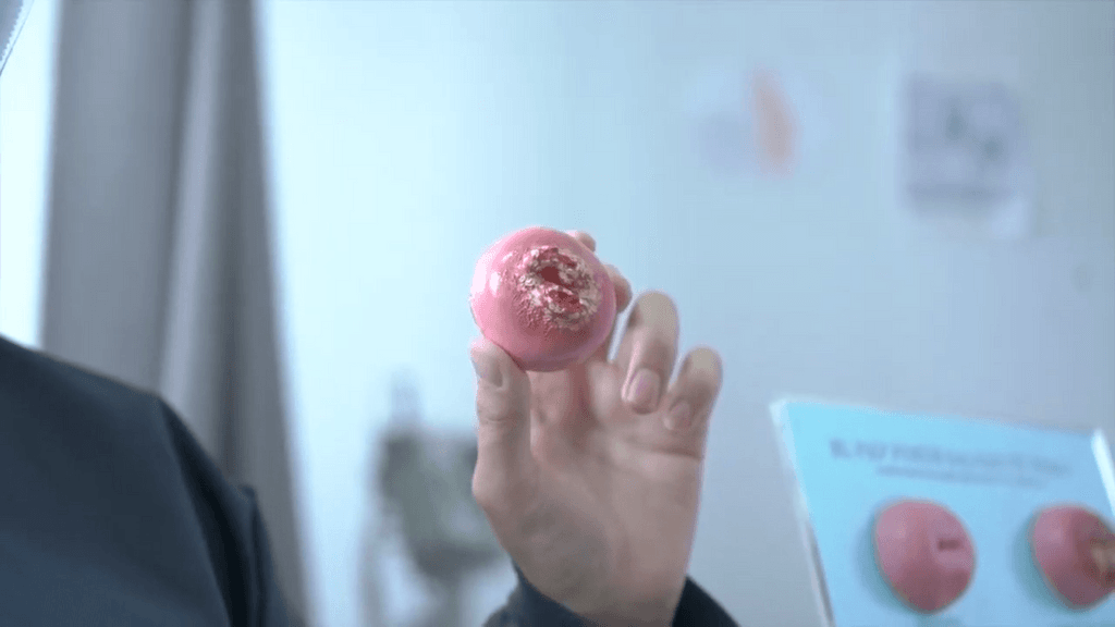 cáncer cuello útero cáncer cuello útero