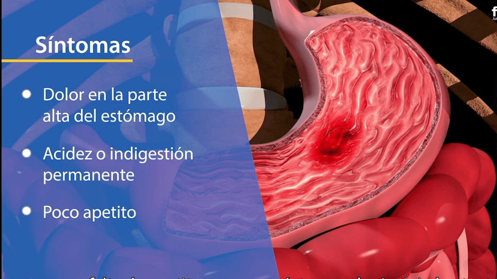 cáncer gastrointestinal cáncer gastrointestinal