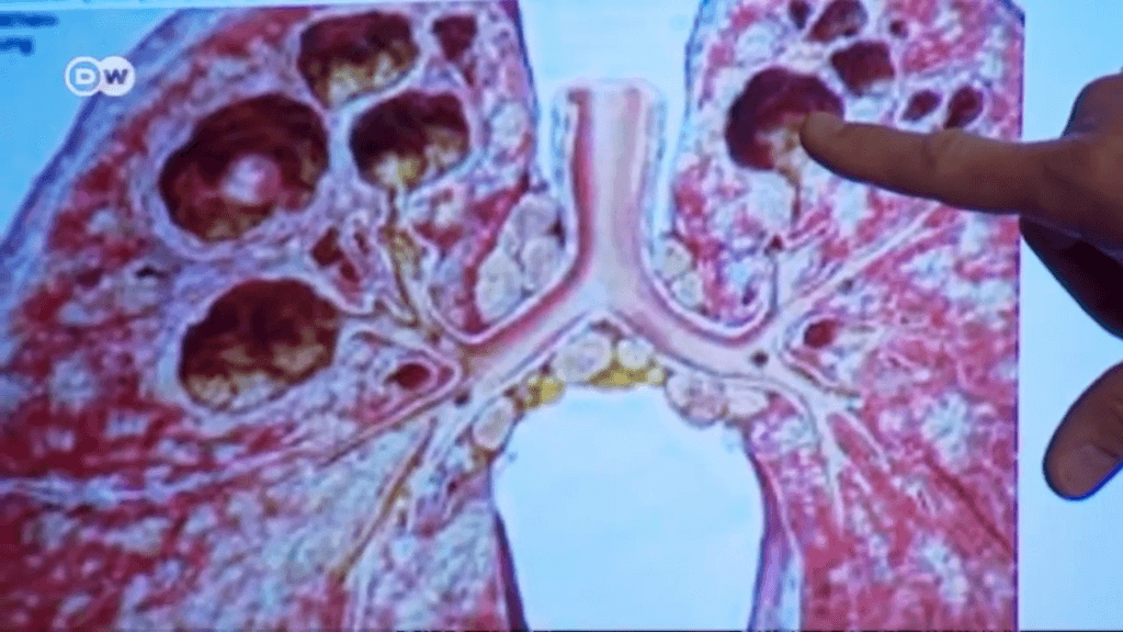 tuberculosis tuberculosis