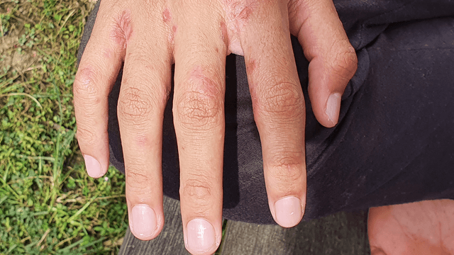 Escabiosis Escabiosis