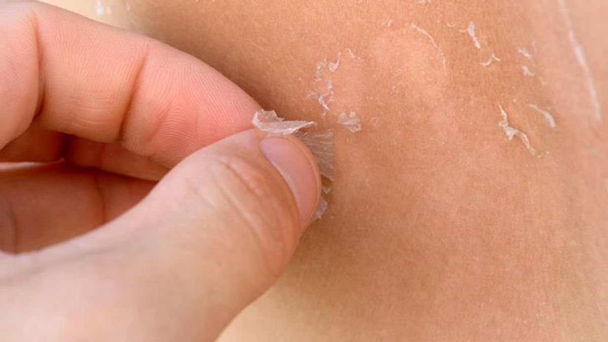 Piel Quemada Piel Quemada