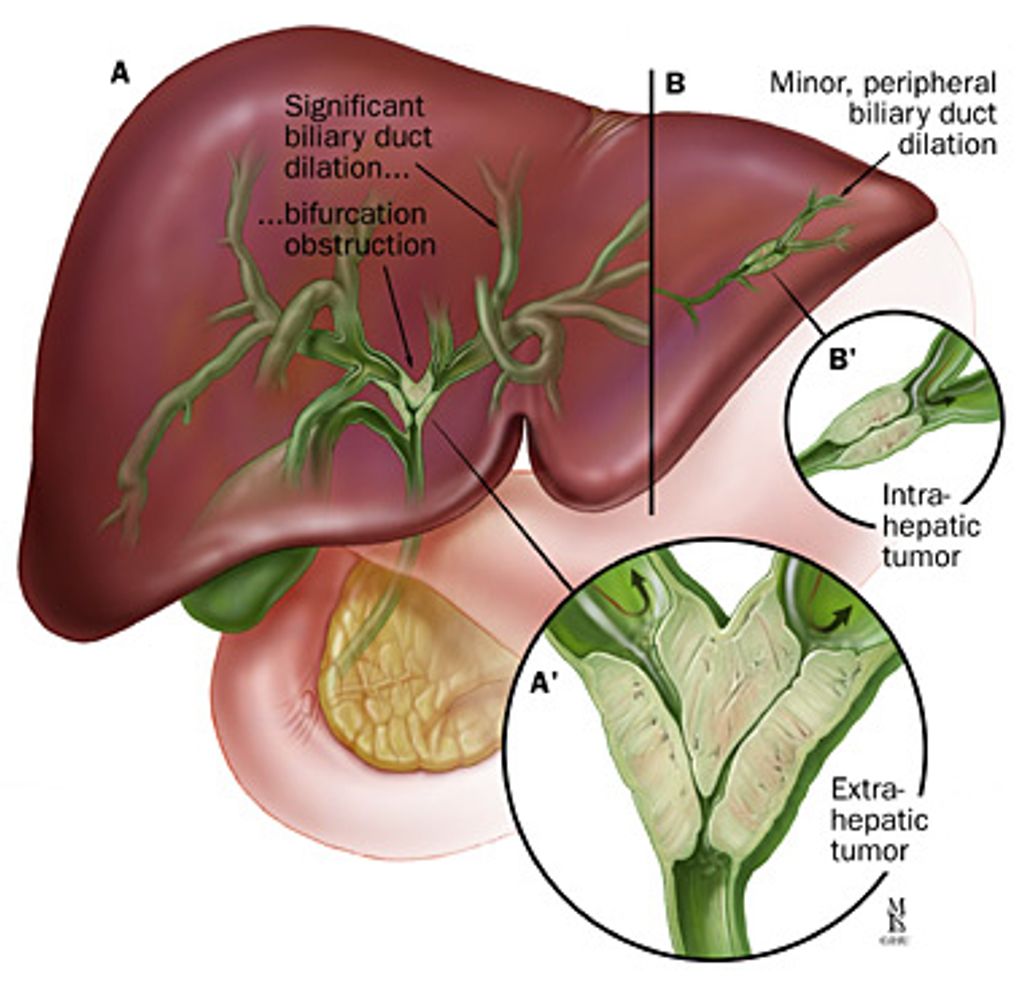 Colangiocarcinoma Colangiocarcinoma