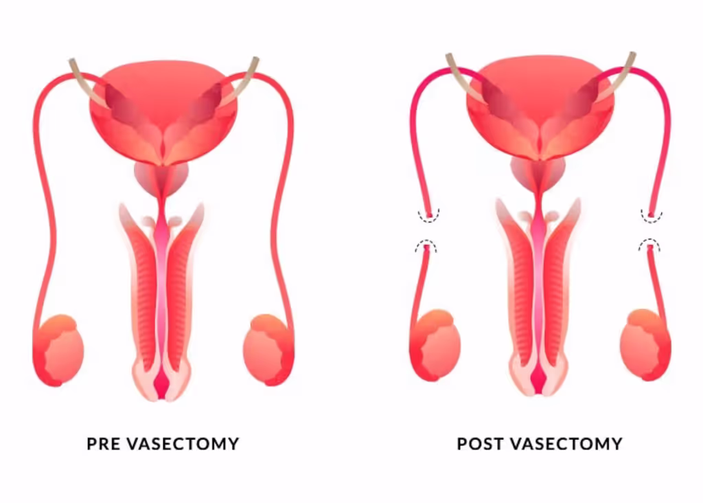 Vasectomia Vasectomia
