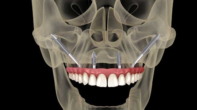 prótesis óseas y dentales prótesis óseas y dentales