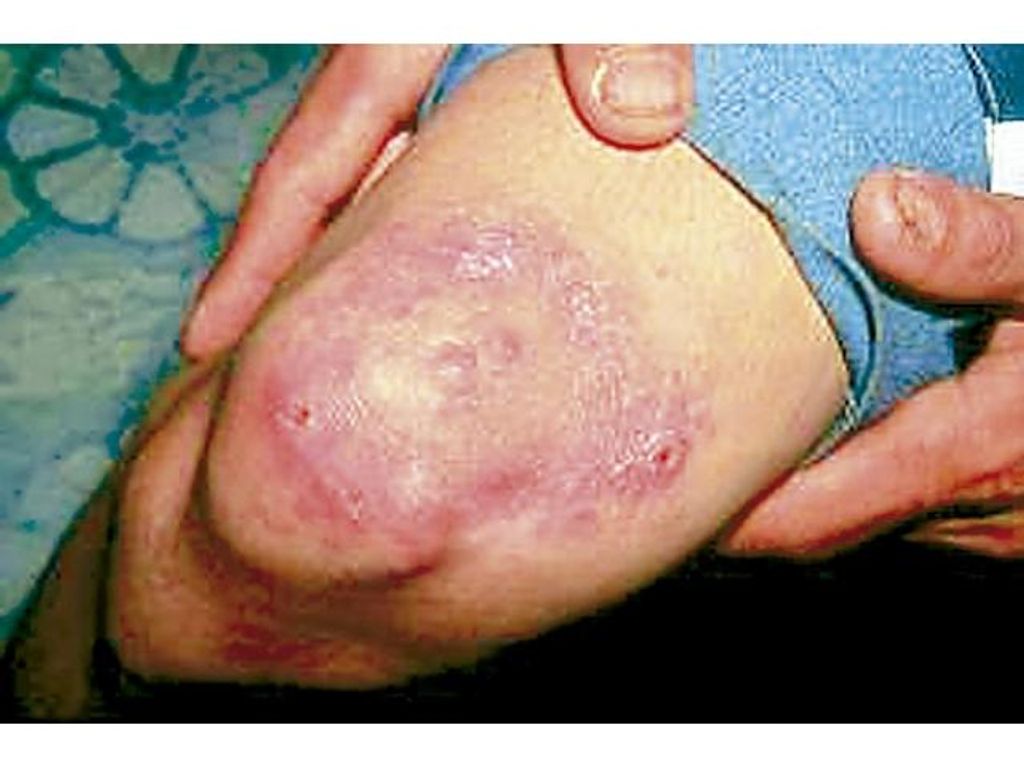 LEPRA: UNA ENFERMEDAD YA CONOCIDA POR DERMATÓLOGOS EN CHILE